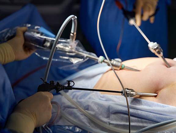 Laser Fissure Surgery